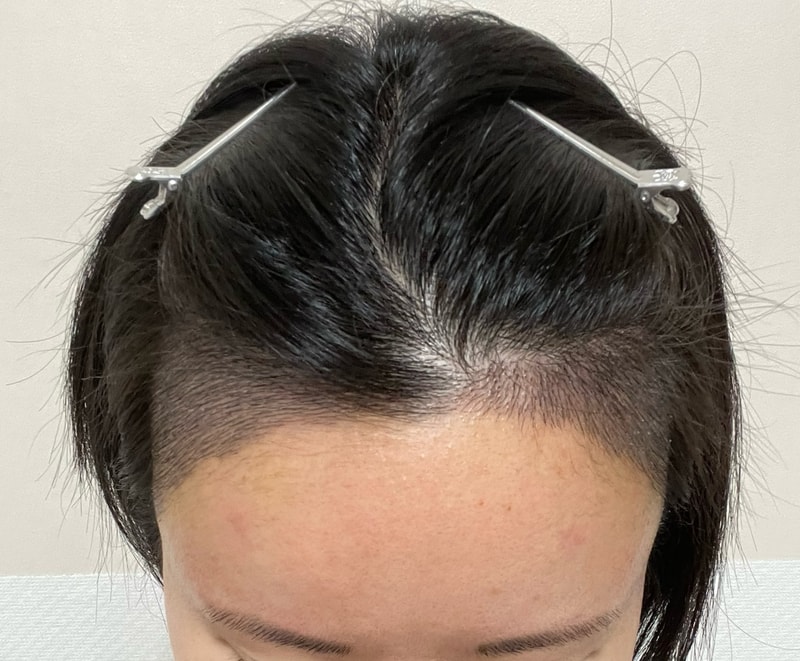 MOJELIM Hair Transplant) Director Lee Won-seok's review of the female hairline for a week.