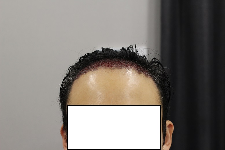 ★The review of the 11th day of the Hair Transplant of 5,000 mosaics of the MOPRO member.