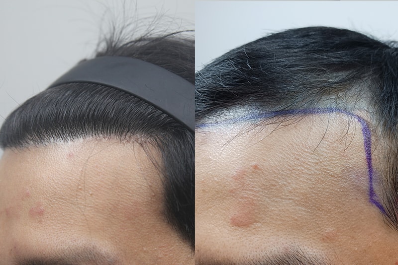 망한 M자 두피문신 완벽하게 가려진 모나라 모발이식 8개월 후기