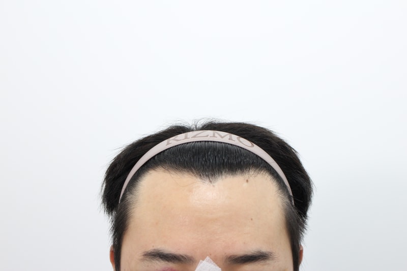 부산리즈모의원 모발이식8개월경과