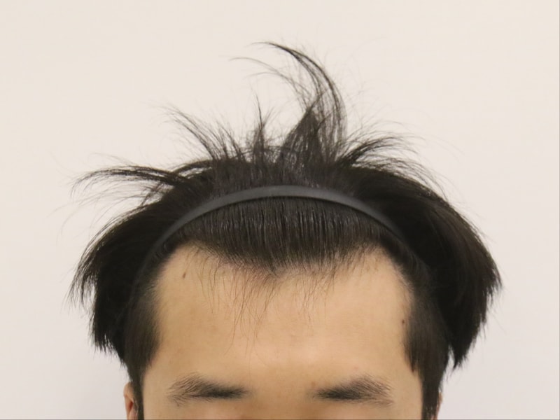 부산모발이식 슬릿방식 맘모스 M자 수술 4개월 후기