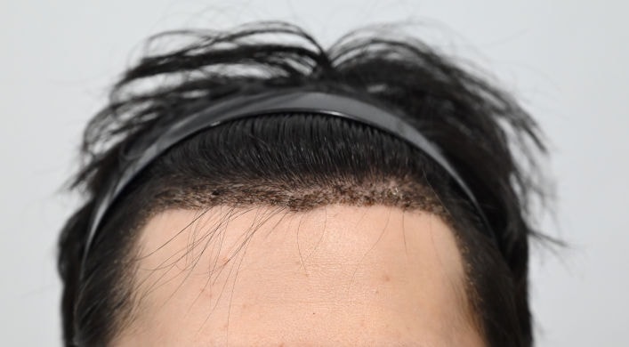 [MOEM Clinic] It's been 3 months since Hair Transplant's hidden cut.