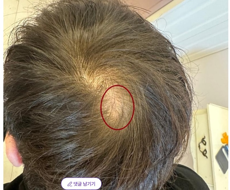 This is a two-year review of the top of the head hair transplant.
