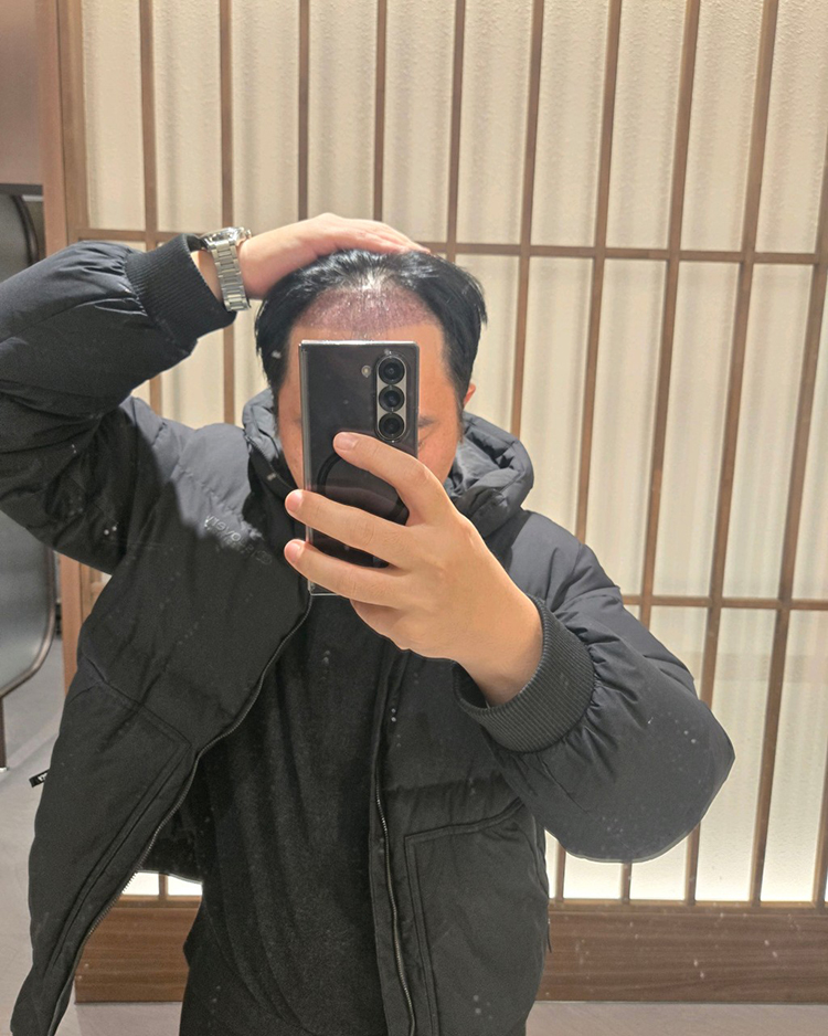 가족력 있는 탈모 대전에서 모발이식 받았습니다.