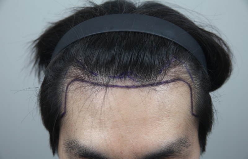 모발이식 1일차 후기입니다(모나라피부과)