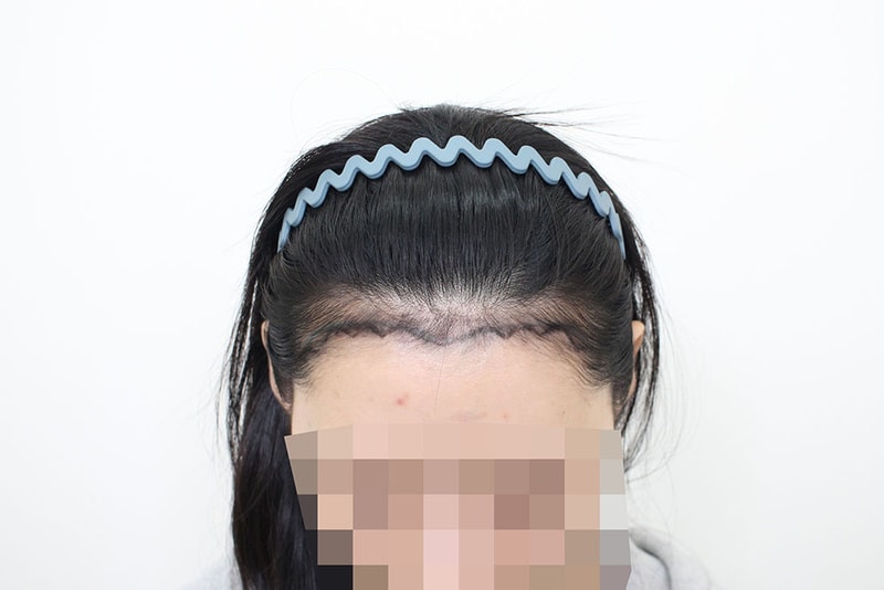 모프로의원, 여성헤어라인, 15일차 후기