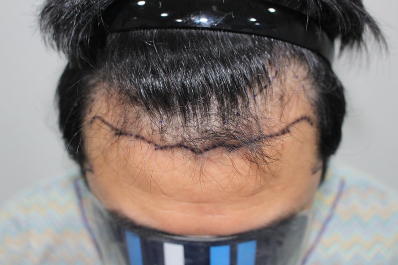 Moderhamm Clinic — Hair Transplant Center Director Jeong Han-byul, after 2 weeks of M-shape + side non-excision,