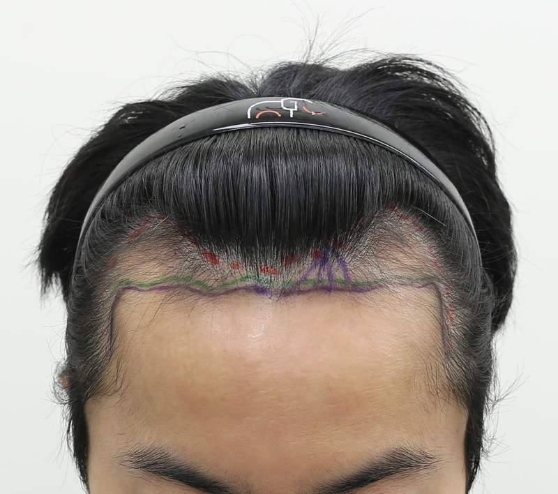 Apgujeong Mammoth Hair Restoration Center Non-Sectionary Sapphire Slit Hair Transplant Review