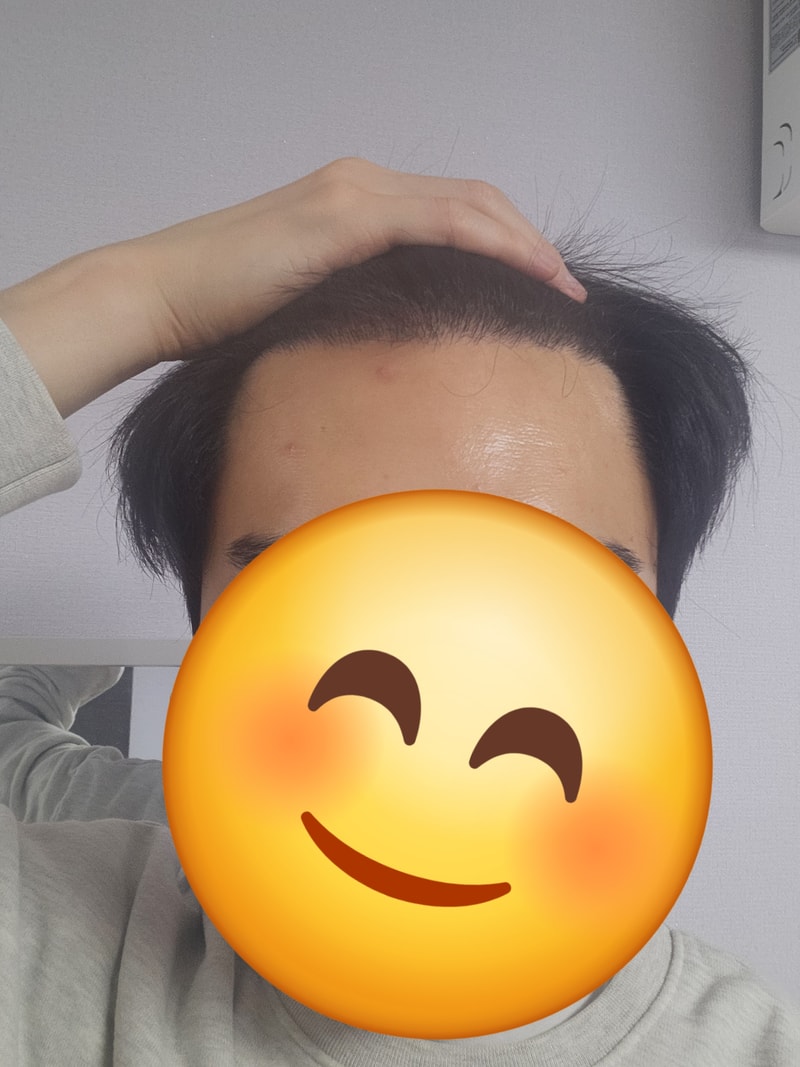 뉴헤어 모발이식 7개월 차, 라인은 대만족! 밀도는 1년까지 \'존버\' 중입니다