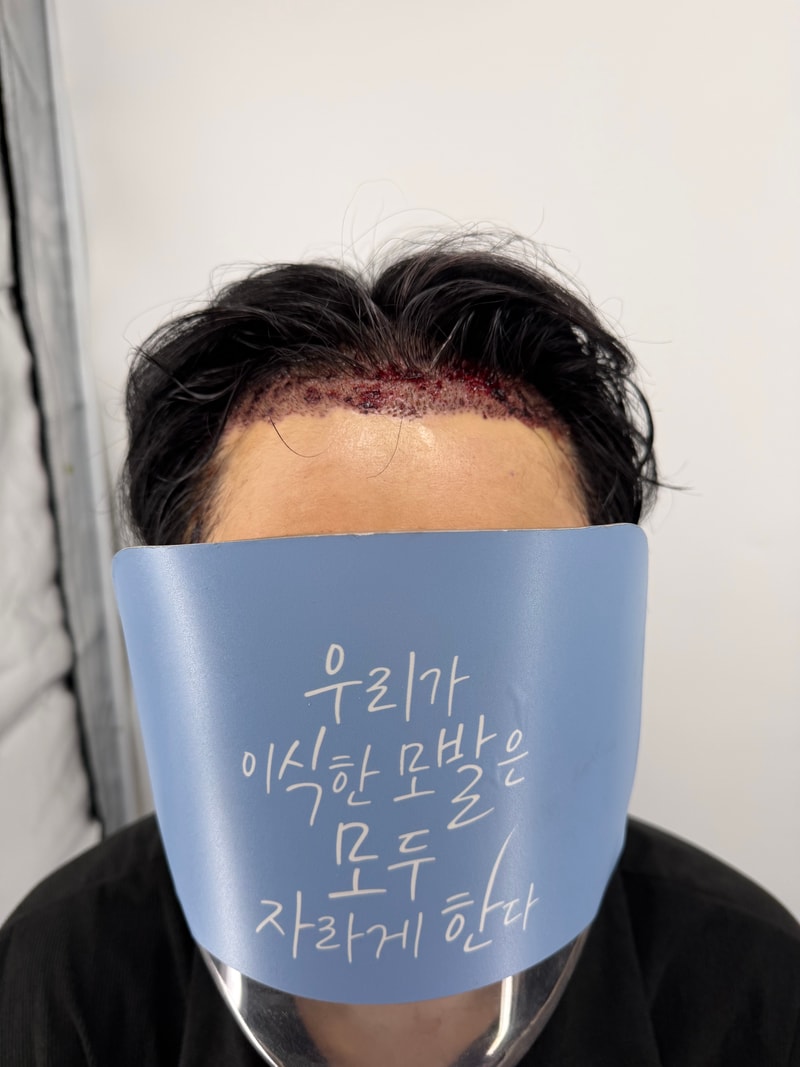 강남모발이식병원 뉴헤어 2일차 비절개 모발이식 후기 입니다~ 1200모낭 했어요~