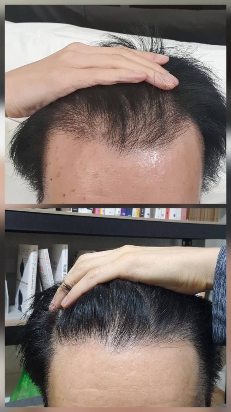 모발이식 1년 8개월 지났네요 ㅎㅎ