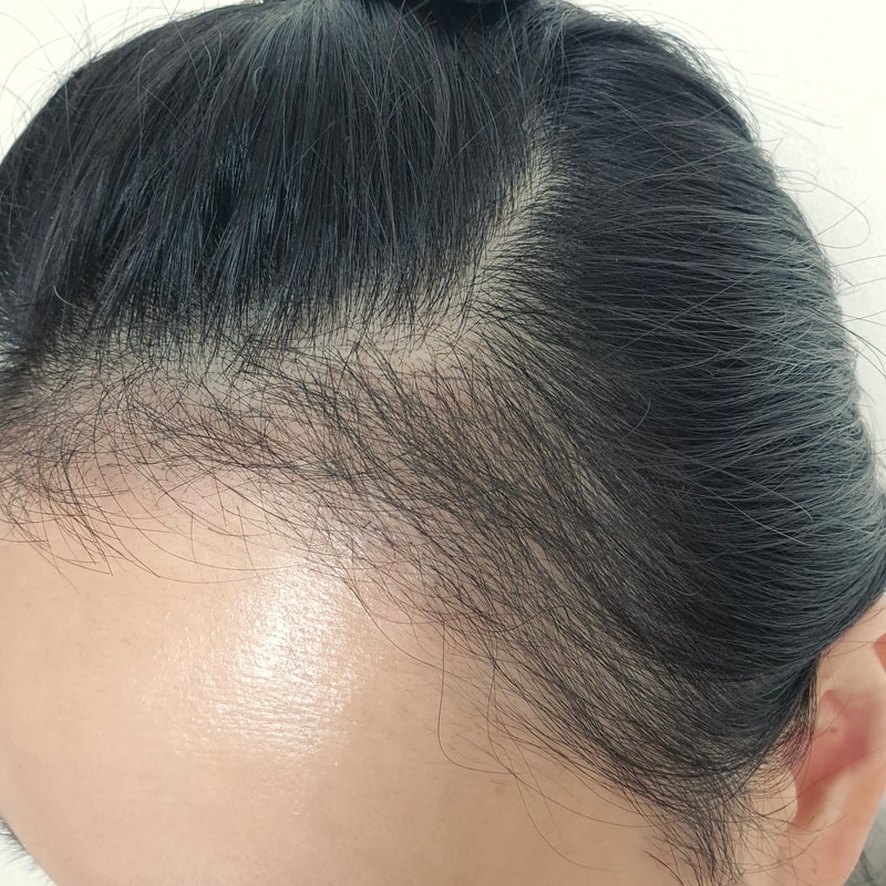 [뉴헤어] 모발이식 3개월차