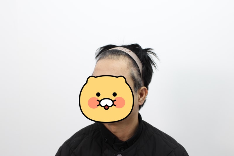 부산리즈모의원 모발이식 12개월경과