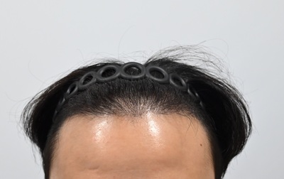 [모엠의원] 남자 C형 탈모 비절개 히든컷 수술 5개월차 후기