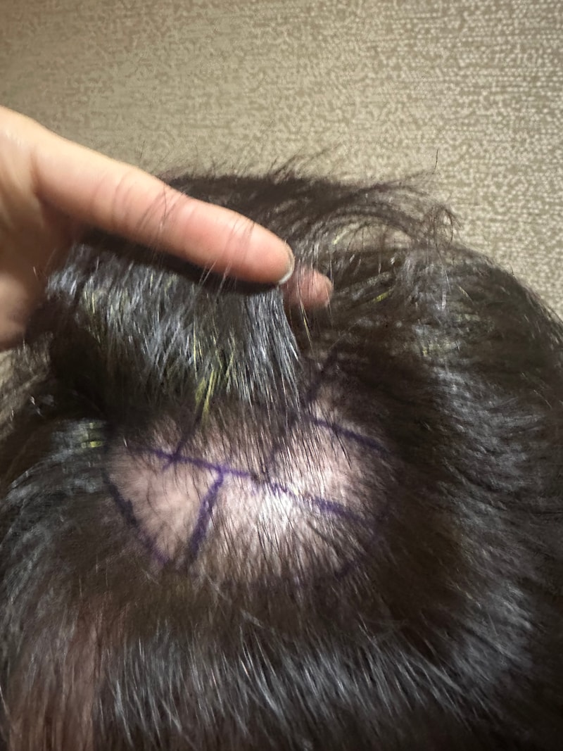 ニューヘアー 植毛14日、体験談です。
