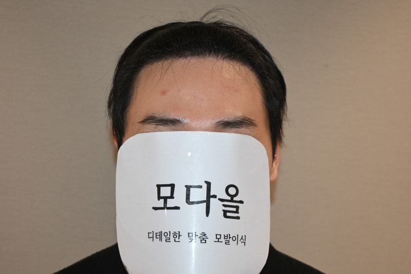 모다올의원 [홍준현 원장님] 수술후기 6개월차