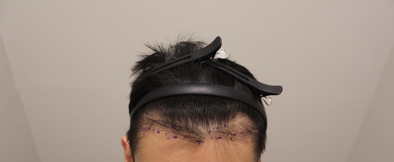 인천 마이모의원 수술후기입니다 14일차