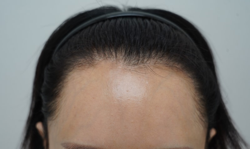 [연세모나의원] 40대 헤어라인교정 2번째 수술 후기