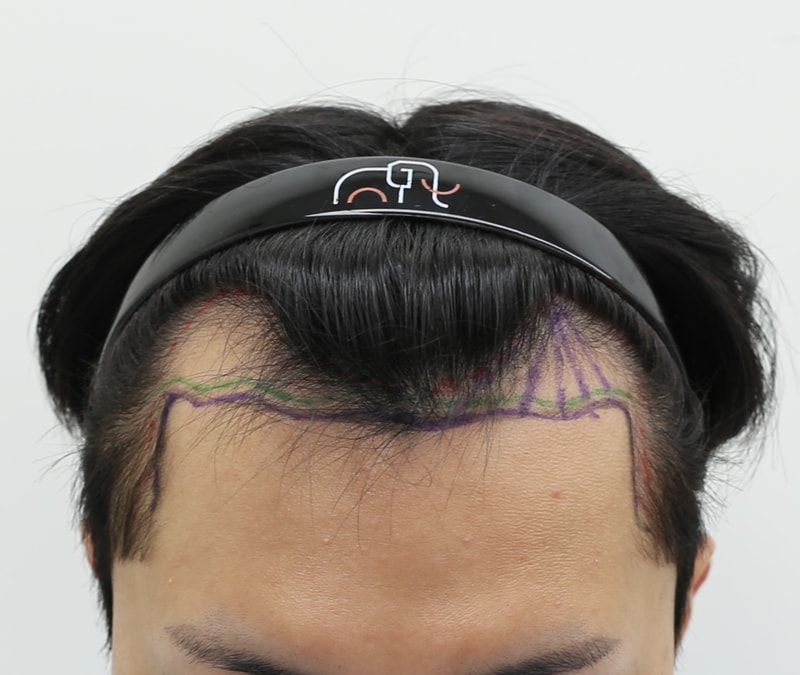 Review on the day of surgery at Hairline Clinic in Mammoth Hair Restoration Center, Apgujeong (Director Seok Ji-woong)