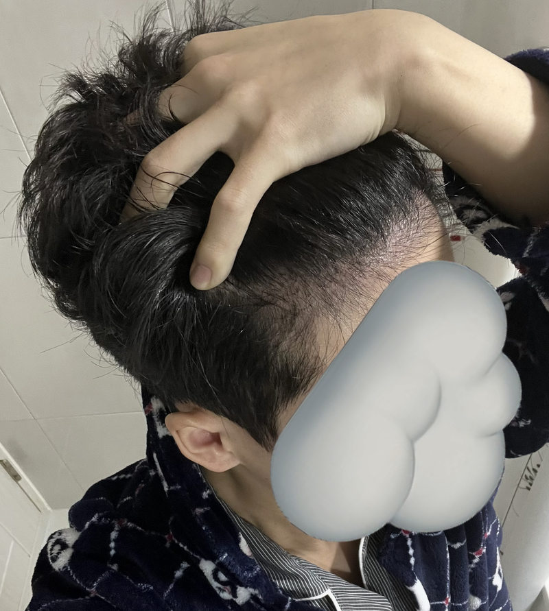 Motherhood 4th Month Hair Transplant Photo Reviews