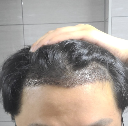 용닥터의원 김용빈 원장님 3200모 5일차 후기 공유합니다 