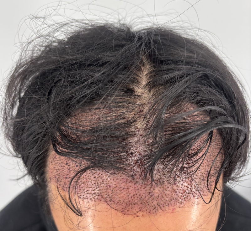 非切開部分刈り上げ体験談手術 M字（2550毛包／ニューヘアー中心）【植毛毛髪形成外科】