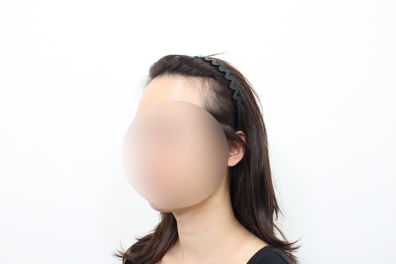 신사역,모프로의원,문건학원장님,지인추천 여성헤어라인이식 절개 3800모,7개월 경과