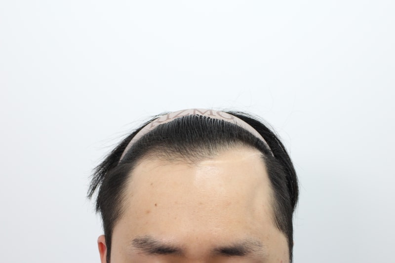 부산리즈모의원 모발이식 12개월차경과