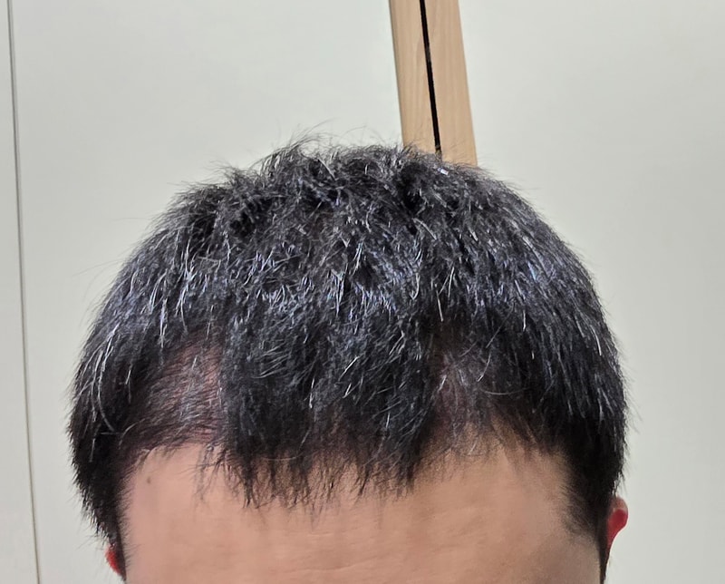 모발이식 경과