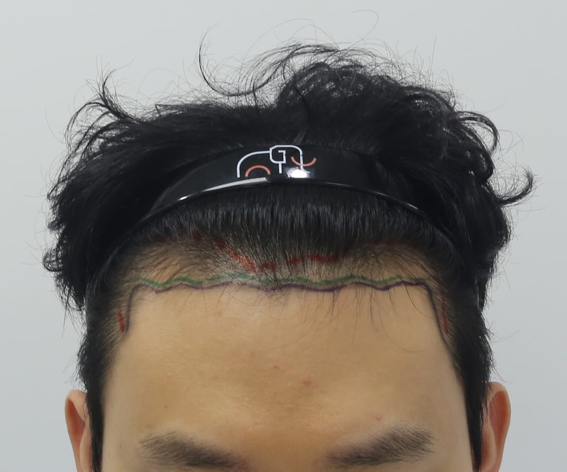 압구정 맘모스 비절개 모발이식 4개월 경과