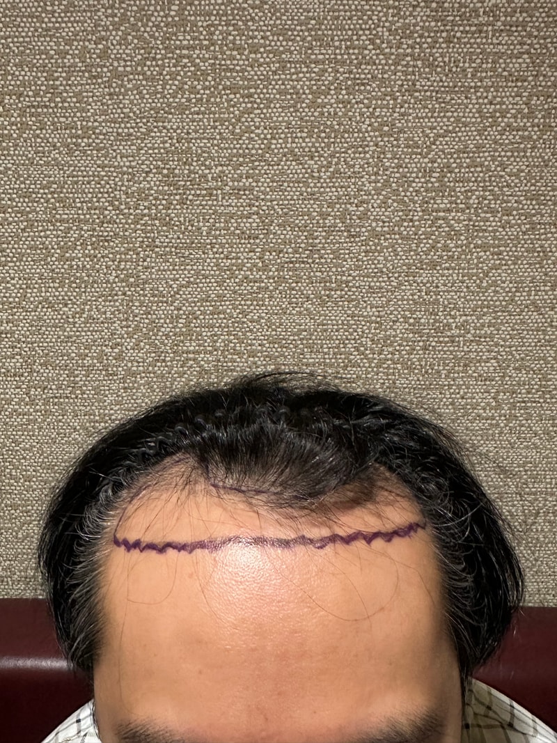 ニューヘアーの非切開2000毛包植毛、4日目の体験談です。
