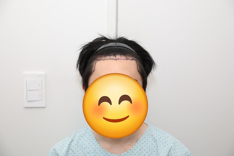 [뉴헤어 모발이식 9개월 차 후기] 곱슬 머리도 대만족! 자연스럽게 꽉 채워진 헤어라인