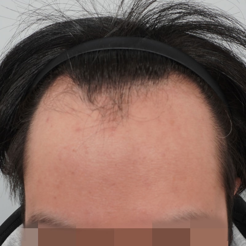 서진성형외과 비절개 4300모 1년 지난 후기 