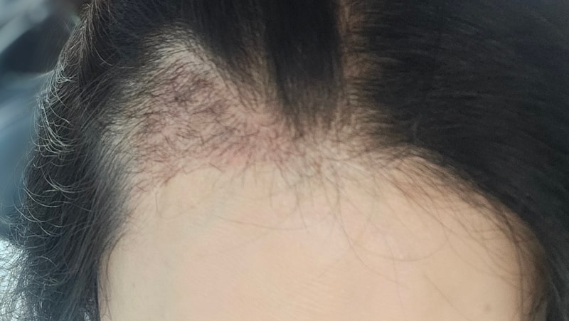 헤어라인 모발이식 한달차 후기