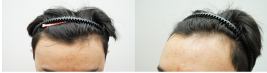 [연세모나의원]이마 M자 라인 모발이식 후기 10개월차