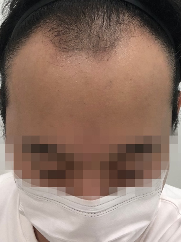 모디헤어플란트 4000모 이식 1년 지났어요