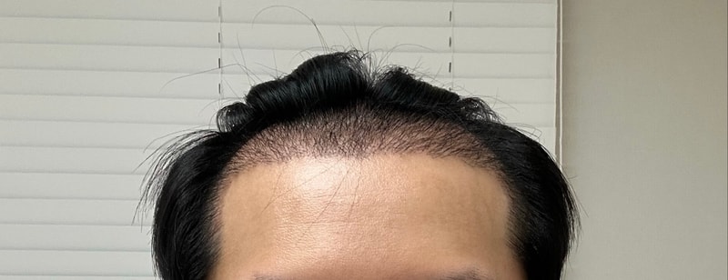 Director Kim Yong-bin, I'm sharing the second week of M-shaped Hair Transplant 4000.
