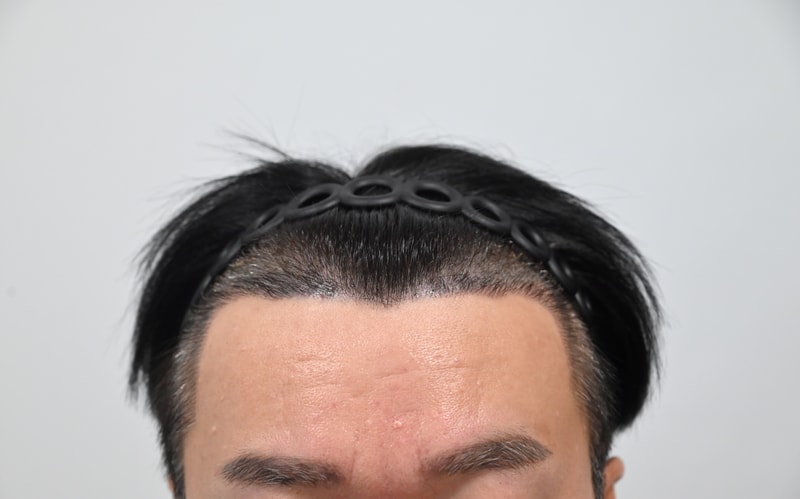 모엠의원 비절개 3개월 지났어요.