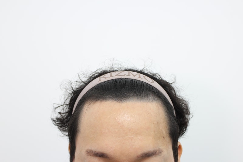 부산리즈모의원 모발이식8개월경과