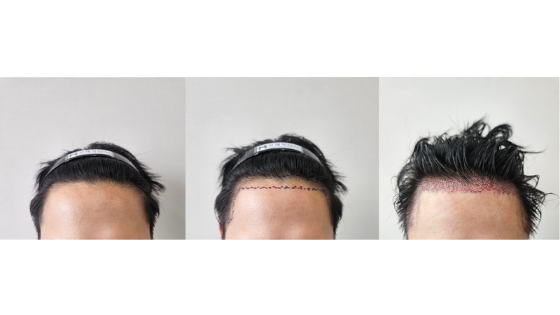 Non-cut 1350 hair follicle treatment review