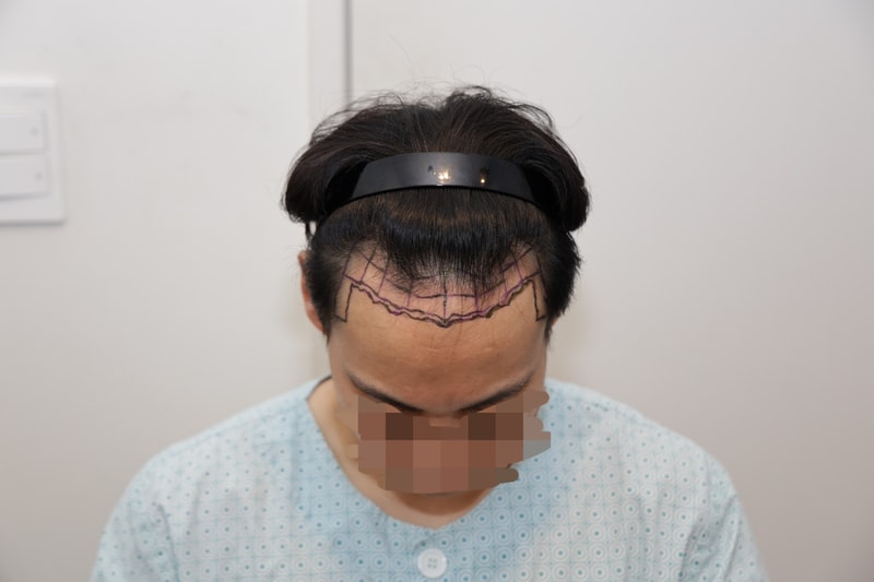 (뉴헤어의원) 모발이식 절개 4000모 1년차 후기