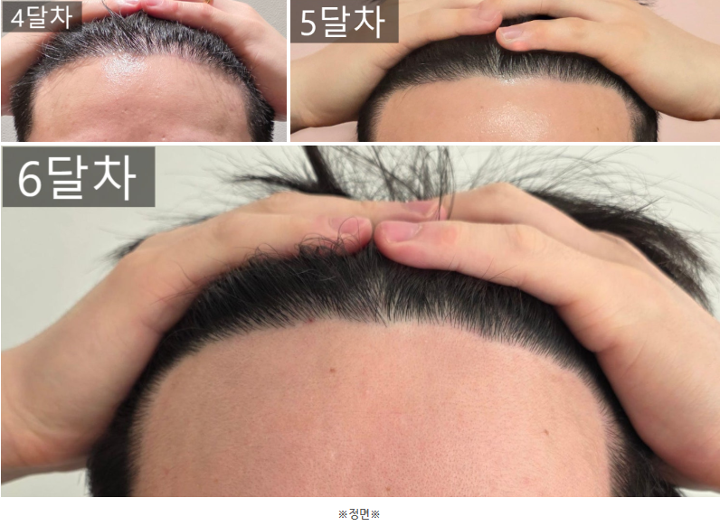 모제림 성형외과의원에서 받은 모발이식 6개월 후기입니다!!!!