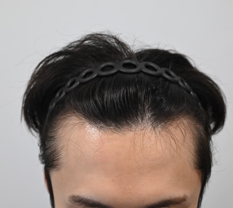 1편 – 시술 전 / 라인 잡기