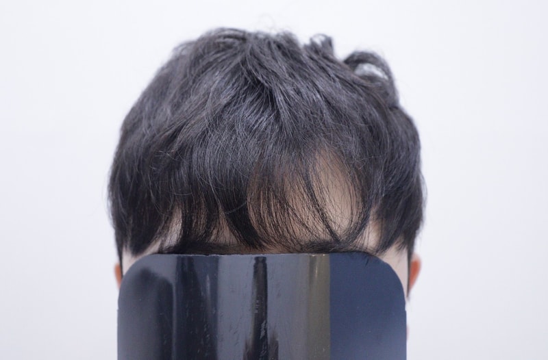 광주 압구정모비앙의원 모발이식 10개월 경과 후기
