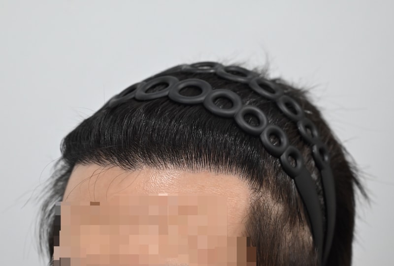 모발이식 3차 후기 최종