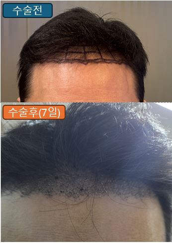 강남 뉴헤어 모발이식 7일차 후기 (비절개·무삭발 / 1600모낭)