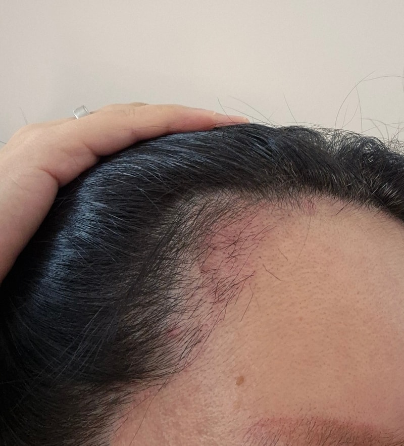 A month's review of hairline Hair Transplant.