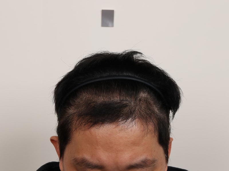 Busan Mammoth Hairline Slit Method M-Shape + All Over 4 Months