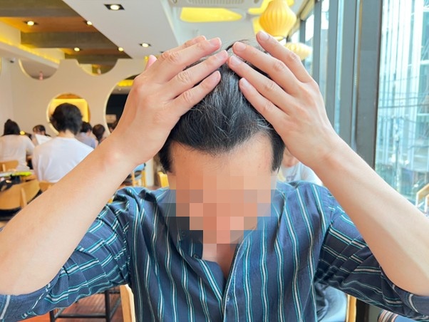한국까지 와서 모발이식 받은 보람 있네요