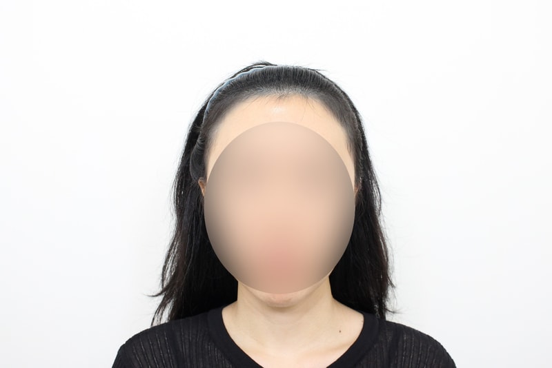 신사역 모프로의원 문건학원장님 여자 헤어라인교정 모발이식 절개 4200모 6개월 경과